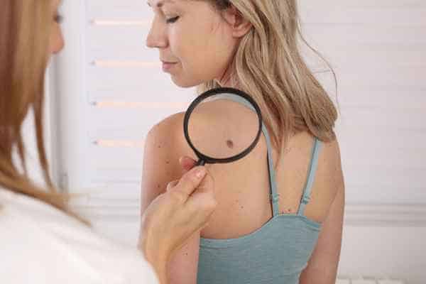 What Are Traditional Skin Lesion Removal Methods Bridport?