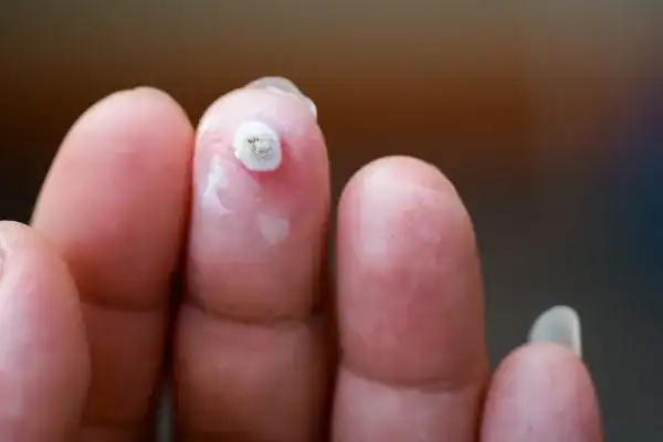Image of white wart before cryopen treatment Bridport