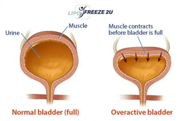 diagram of overactive bladder treatment Bridport