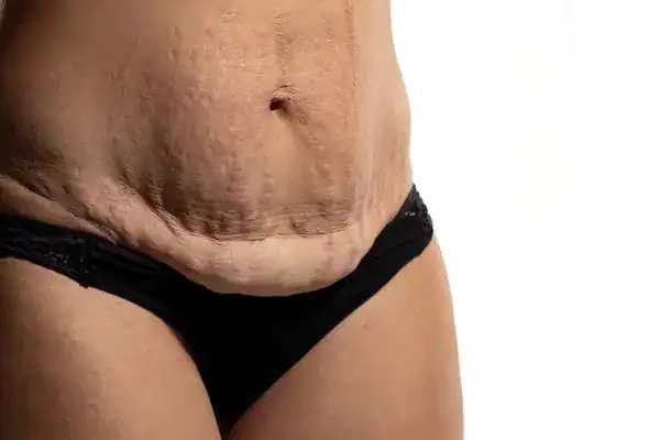 loose skin after weight loss injections Bridport