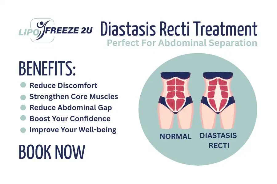 Benefits of body toning treatment Bridport for Diastasis recti