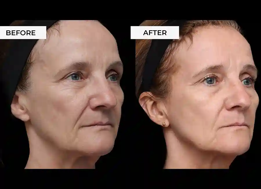 How Many RF Microneedling Sessions Will You Need to See a Difference Bridport?