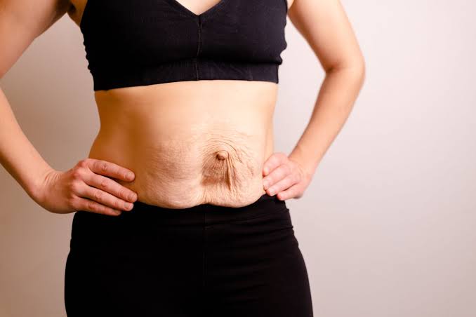 Is Surgery Really the Only Way to Repair Diastasis Recti Bridport?