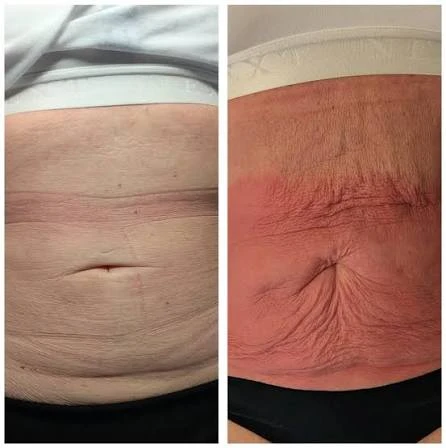How Does RF Microneedling Improve Crepey, Thin and Uneven Skin Texture Bridport?