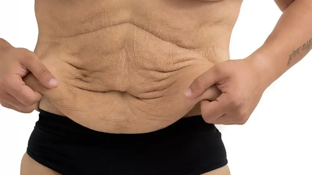 RF Microneedling for Loose Skin: How Can It Help Tighten and Reshape the Skin Bridport?